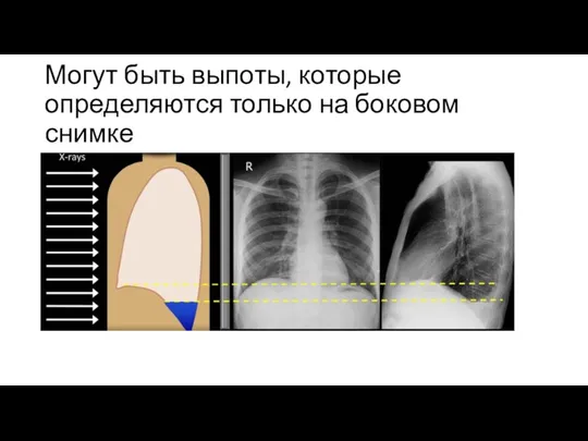 Могут быть выпоты, которые определяются только на боковом снимке