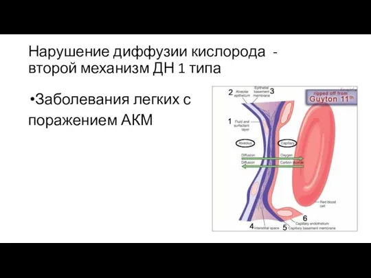 Нарушение диффузии кислорода - второй механизм ДН 1 типа Заболевания легких с поражением АКМ