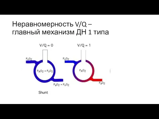 Неравномерность V/Q – главный механизм ДН 1 типа