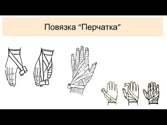 Повязка “Перчатка”