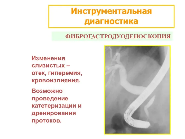 Инструментальная диагностика ФИБРОГАСТРОДУОДЕНОСКОПИЯ Изменения слизистых – отек, гиперемия, кровоизлияния. Возможно проведение катетеризации и дренирования протоков.