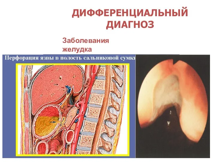 ДИФФЕРЕНЦИАЛЬНЫЙ ДИАГНОЗ Заболевания желудка