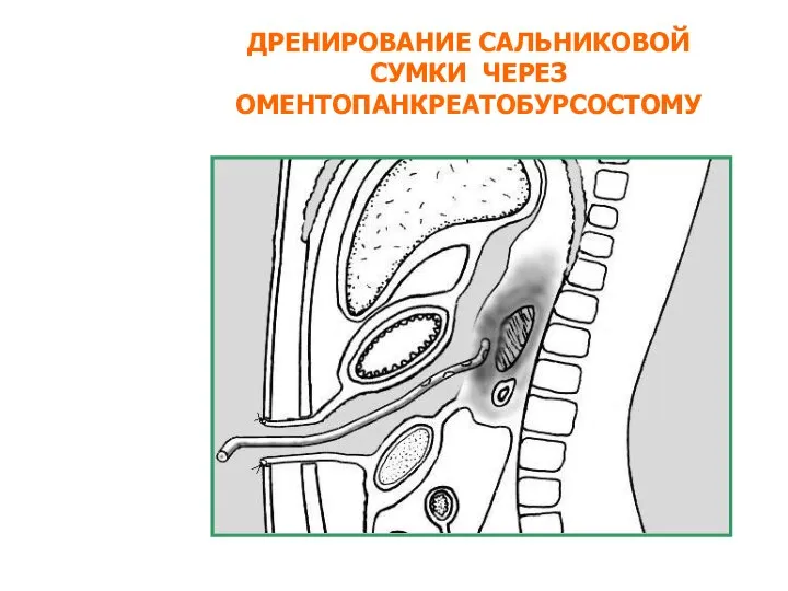 ДРЕНИРОВАНИЕ САЛЬНИКОВОЙ СУМКИ ЧЕРЕЗ ОМЕНТОПАНКРЕАТОБУРСОСТОМУ