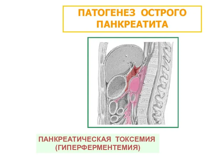 ПАТОГЕНЕЗ ОСТРОГО ПАНКРЕАТИТА ПАНКРЕАТИЧЕСКАЯ ТОКСЕМИЯ (ГИПЕРФЕРМЕНТЕМИЯ)