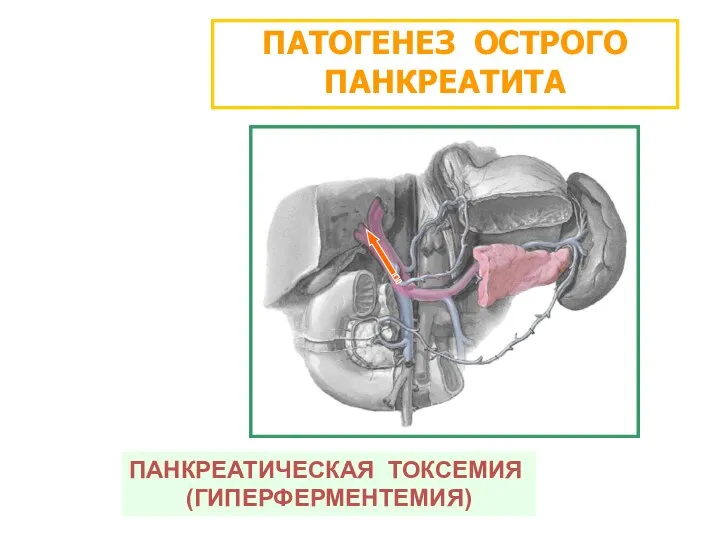 ПАТОГЕНЕЗ ОСТРОГО ПАНКРЕАТИТА ПАНКРЕАТИЧЕСКАЯ ТОКСЕМИЯ (ГИПЕРФЕРМЕНТЕМИЯ)