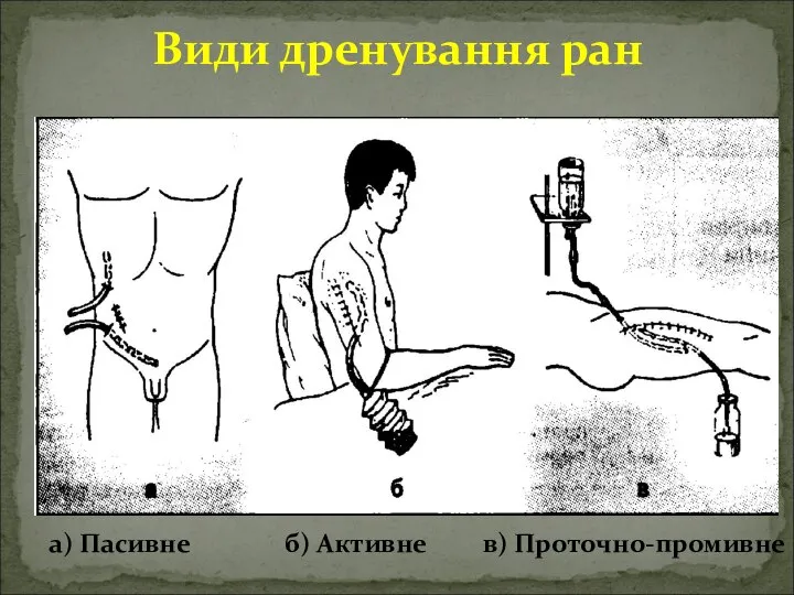 Види дренування ран а) Пасивне б) Активне в) Проточно-промивне
