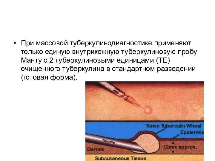 При массовой туберкулинодиагностике применяют только единую внутрикожную туберкулиновую пробу Манту с