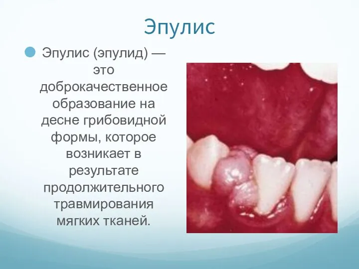 Эпулис Эпулис (эпулид) — это доброкачественное образование на десне грибовидной формы,