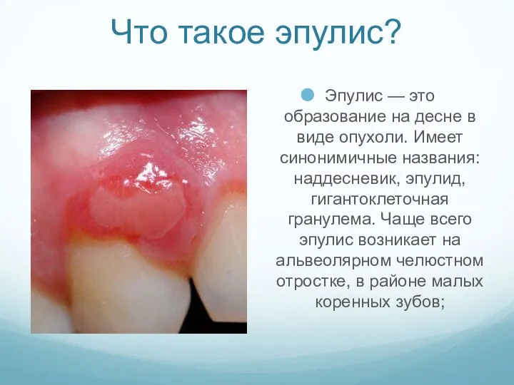 Что такое эпулис? Эпулис — это образование на десне в виде