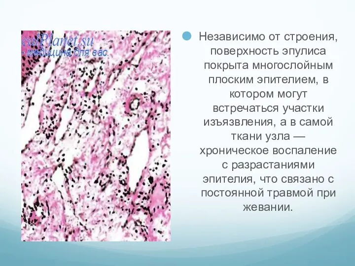 Независимо от строения, поверхность эпулиса покрыта многослойным плоским эпителием, в котором