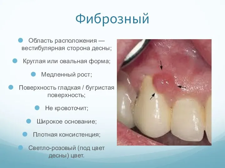 Фиброзный Область расположения — вестибулярная сторона десны; Круглая или овальная форма;