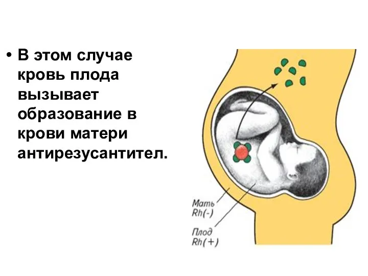 В этом случае кровь плода вызывает образование в крови матери антирезусантител.