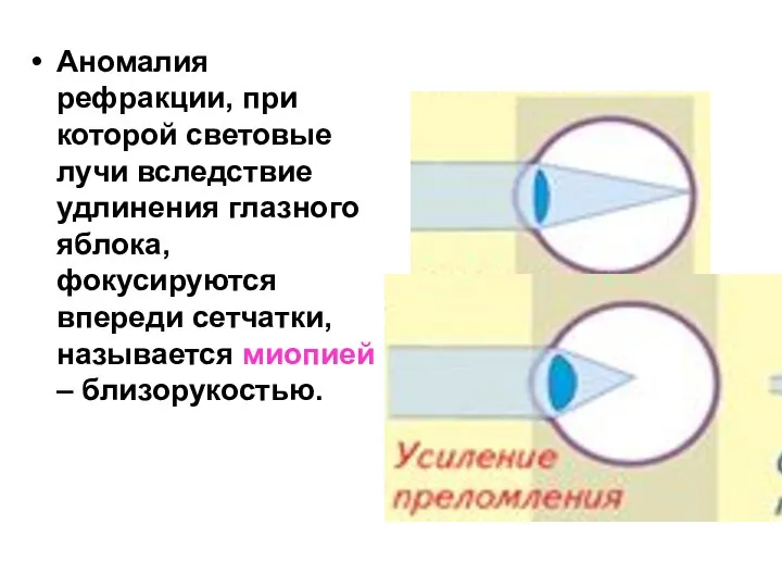 Аномалия рефракции, при которой световые лучи вследствие удлинения глазного яблока, фокусируются