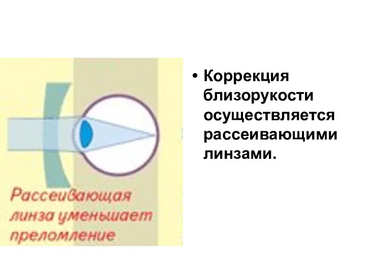 Коррекция близорукости осуществляется рассеивающими линзами.