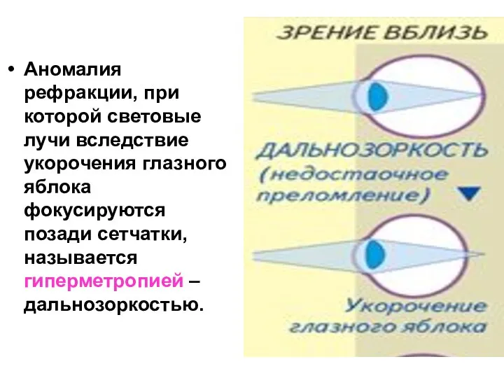 Аномалия рефракции, при которой световые лучи вследствие укорочения глазного яблока фокусируются