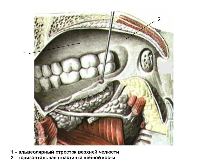 1 1 – альвеолярный отросток верхней челюсти 2 – горизонтальная пластинка нёбной кости 2