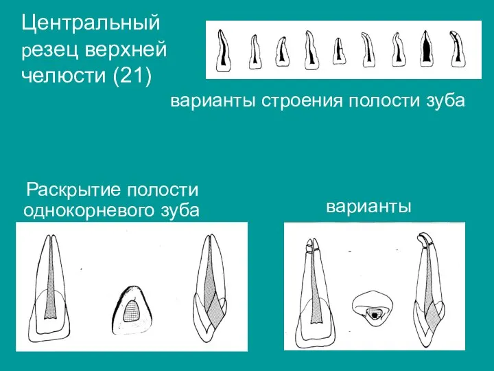 Центральный резец верхней челюсти (21) варианты строения полости зуба Раскрытие полости однокорневого зуба варианты