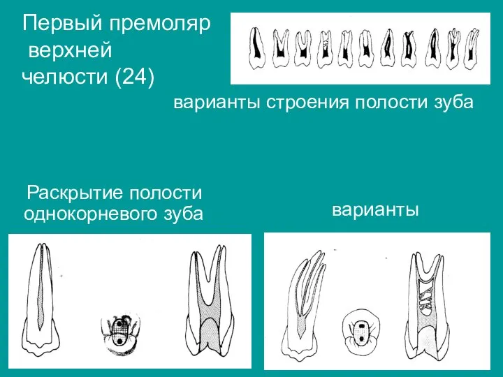Раскрытие полости однокорневого зуба варианты Первый премоляр верхней челюсти (24) варианты строения полости зуба