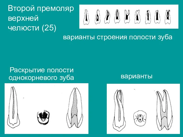 варианты Второй премоляр верхней челюсти (25) варианты строения полости зуба Раскрытие полости однокорневого зуба