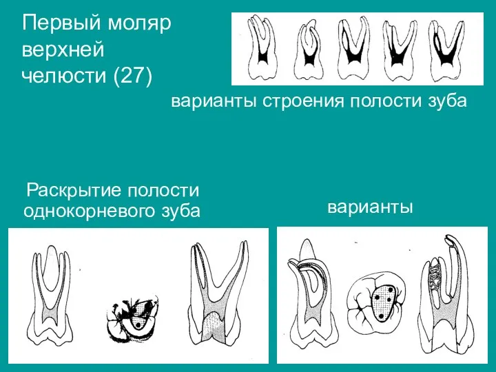 варианты Первый моляр верхней челюсти (27) варианты строения полости зуба Раскрытие полости однокорневого зуба