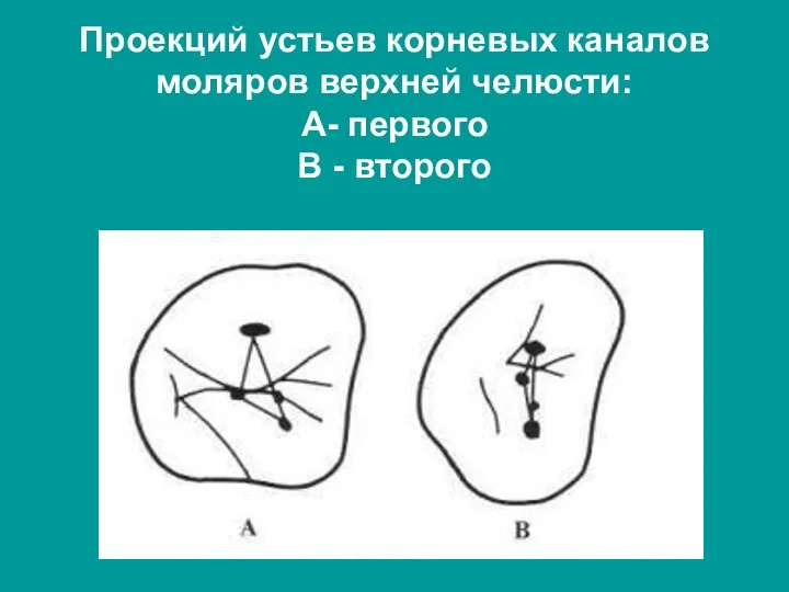 Проекций устьев корневых каналов моляров верхней челюсти: А- первого В - второго