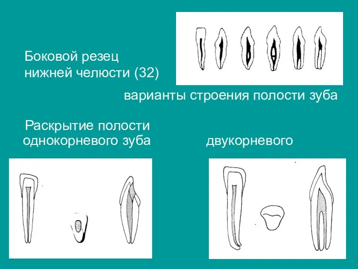 Боковой резец нижней челюсти (32) варианты строения полости зуба Раскрытие полости однокорневого зуба двукорневого