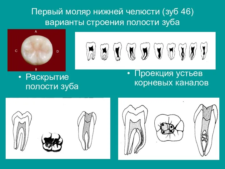 Первый моляр нижней челюсти (зуб 46) варианты строения полости зуба Проекция