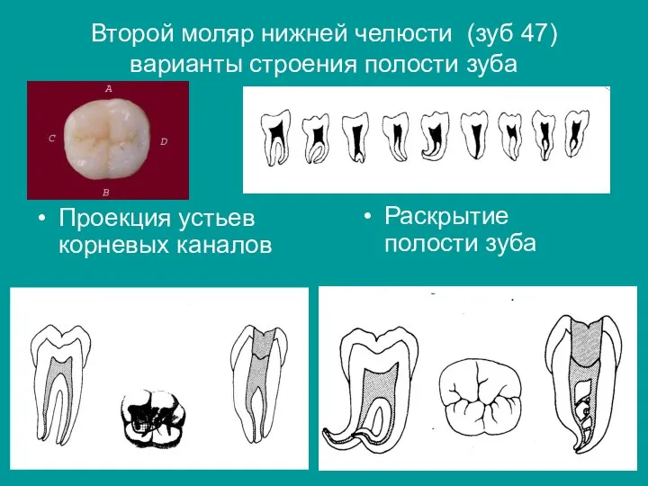 Второй моляр нижней челюсти (зуб 47) варианты строения полости зуба Проекция