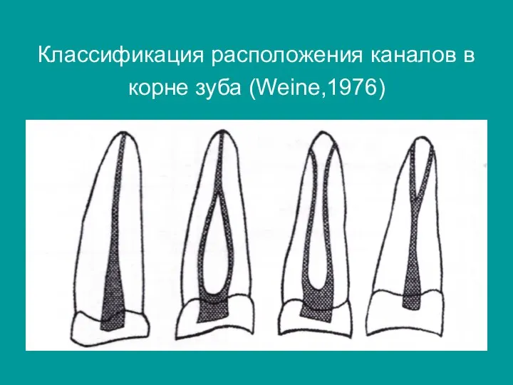 Классификация расположения каналов в корне зуба (Weine,1976)