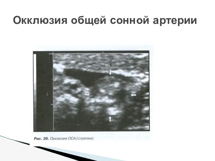 Окклюзия общей сонной артерии