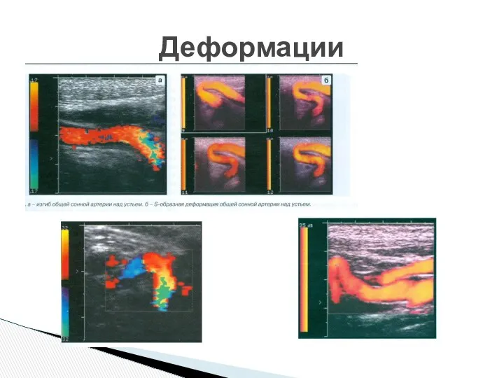 Деформации