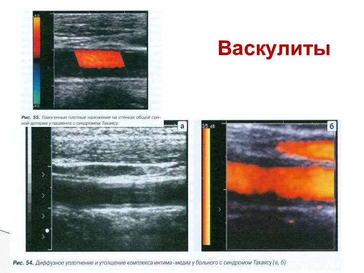 Васкулиты