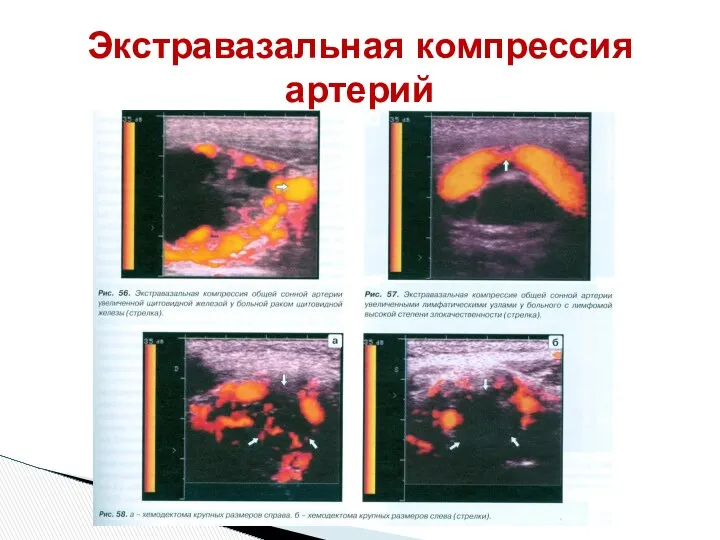 Экстравазальная компрессия артерий