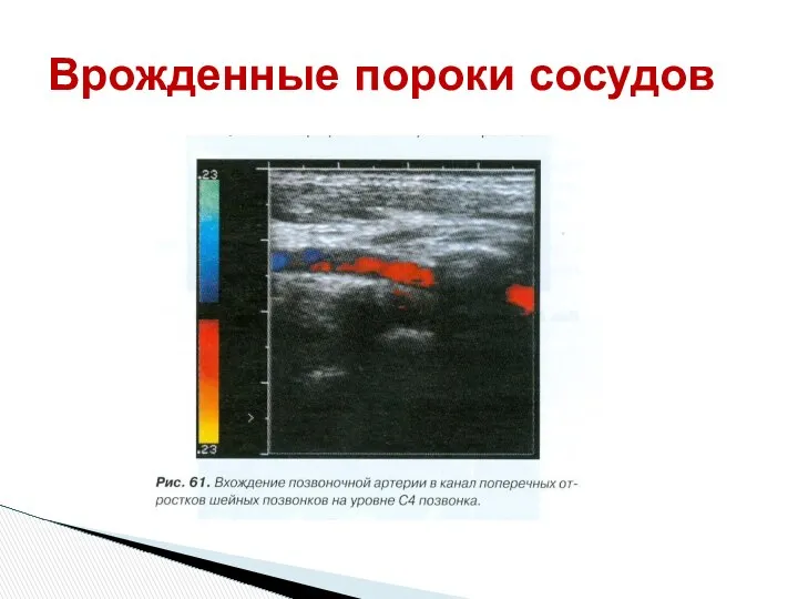 Врожденные пороки сосудов