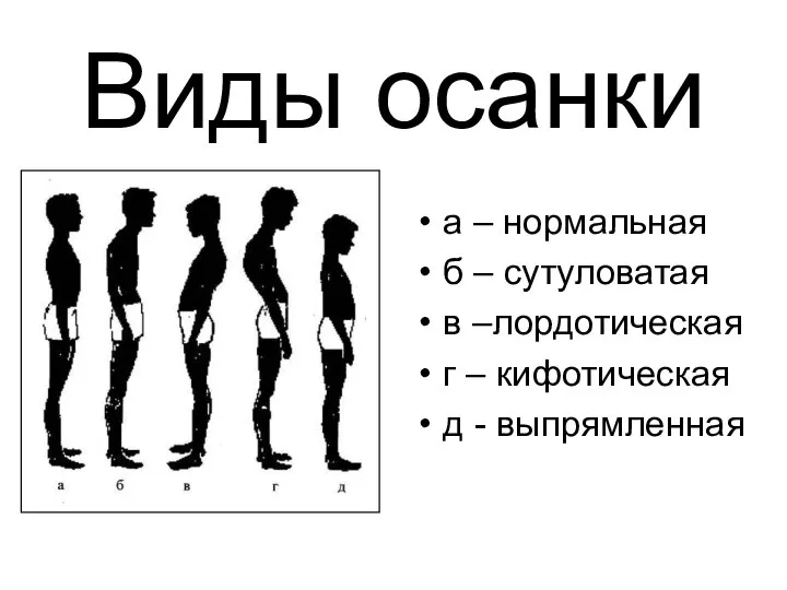 Виды осанки а – нормальная б – сутуловатая в –лордотическая г – кифотическая д - выпрямленная