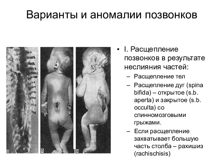 Варианты и аномалии позвонков I. Расщепление позвонков в результате неслияния частей: