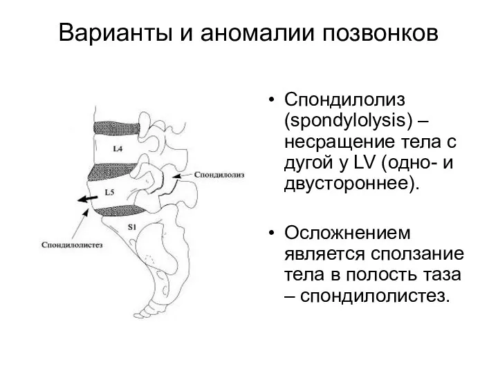 Варианты и аномалии позвонков Спондилолиз (spondylolysis) – несращение тела с дугой