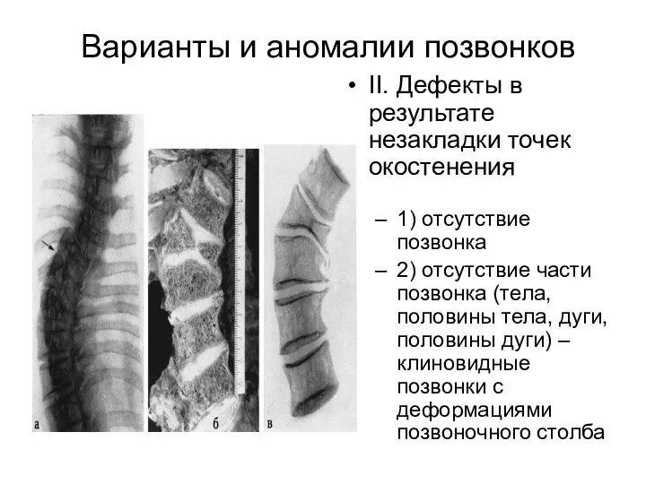 Варианты и аномалии позвонков II. Дефекты в результате незакладки точек окостенения