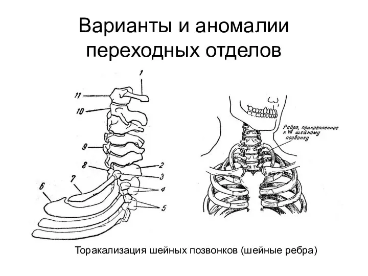 Варианты и аномалии переходных отделов Торакализация шейных позвонков (шейные ребра)