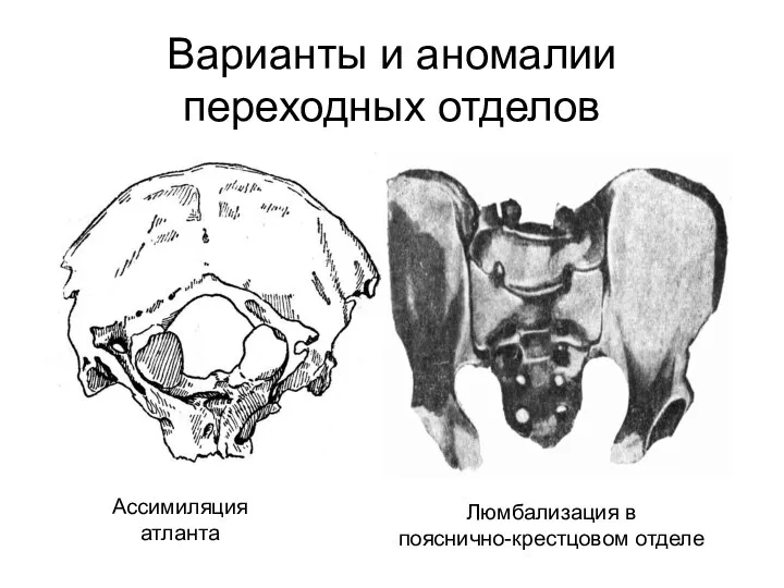 Варианты и аномалии переходных отделов Ассимиляция атланта Люмбализация в пояснично-крестцовом отделе