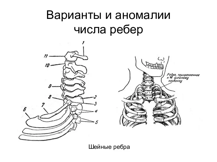 Варианты и аномалии числа ребер Шейные ребра