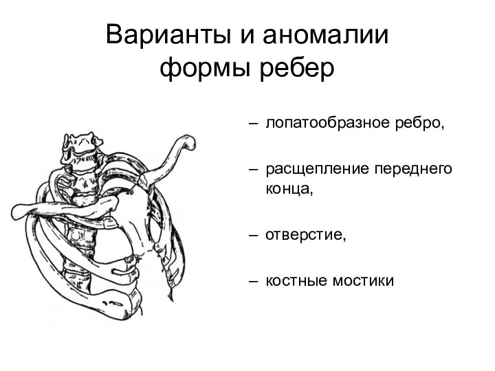 Варианты и аномалии формы ребер лопатообразное ребро, расщепление переднего конца, отверстие, костные мостики