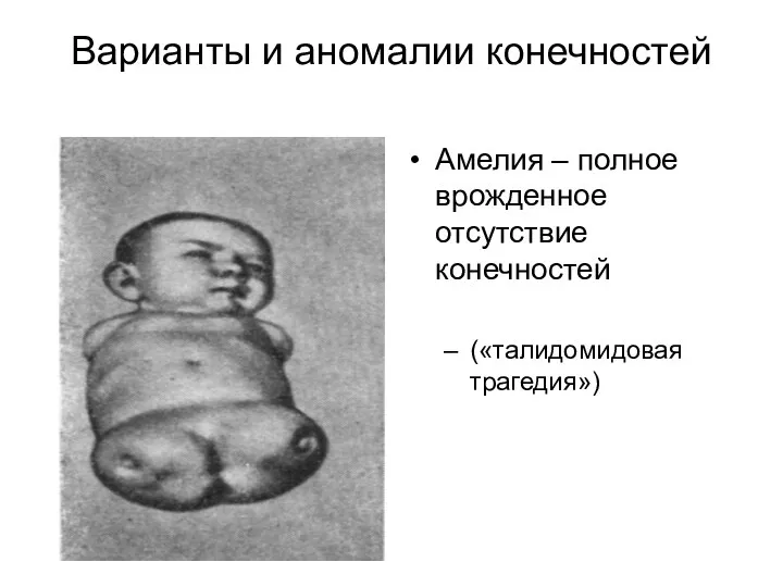 Варианты и аномалии конечностей Амелия – полное врожденное отсутствие конечностей («талидомидовая трагедия»)