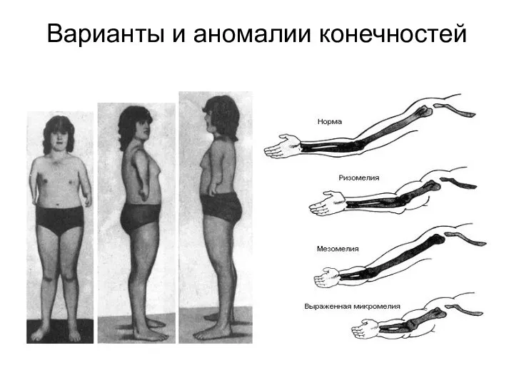 Варианты и аномалии конечностей