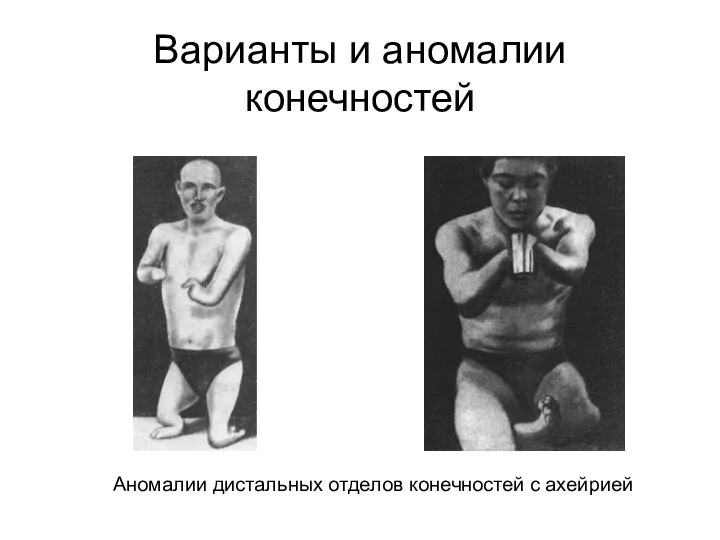 Варианты и аномалии конечностей Аномалии дистальных отделов конечностей с ахейрией