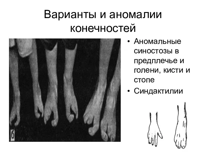 Варианты и аномалии конечностей Аномальные синостозы в предплечье и голени, кисти и стопе Синдактилии