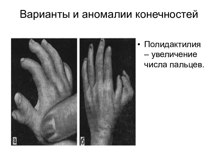 Варианты и аномалии конечностей Полидактилия – увеличение числа пальцев.