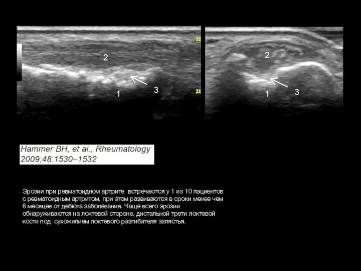 Эрозии при ревматоидном артрите встречаются у 1 из 10 пациентов с