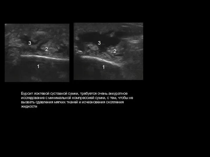 Бурсит локтевой суставной сумки, требуется очень аккуратное исследование с минимальной компрессией