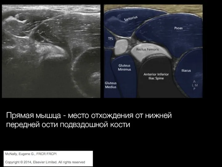 Прямая мышца - место отхождения от нижней передней ости подвздошной кости